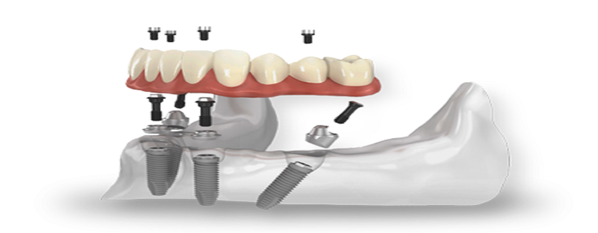 Best dental treatment in vibhuti khand lko