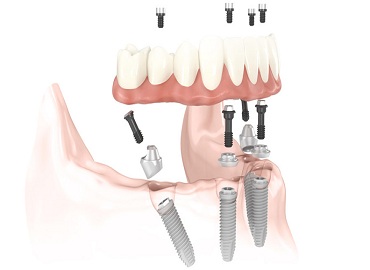 Dental Clinic in Gomti Nagar,Dental Clinic in vibhuti khand,Dental clinic in vishesh khand,dental clinic near shaheed path,Dentist in Gomti Nagar,Dentist in vibhuti khand,Dentist in vishesh khand,Dentist near shaheed path,Dental clinic in lucknow,dentist in lucknow,top dental clinic in gomti nagar,top dental clinic in vibhuti khand,top dental clinic in vishesh khand,top dental clinic  near shaheed path,top dentist in gomti nagar,top dentist in vibhuti khand,top dentist in vishesh khand