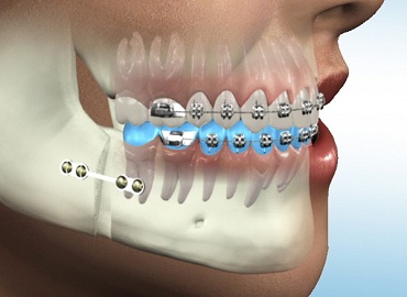 Dental Clinic in Gomti Nagar,Dental Clinic in vibhuti khand,Dental clinic in vishesh khand,dental clinic near shaheed path,Dentist in Gomti Nagar,Dentist in vibhuti khand,Dentist in vishesh khand,Dentist near shaheed path,Dental clinic in lucknow,dentist in lucknow,top dental clinic in gomti nagar,top dental clinic in vibhuti khand,top dental clinic in vishesh khand,top dental clinic  near shaheed path,top dentist in gomti nagar,top dentist in vibhuti khand,top dentist in vishesh khand